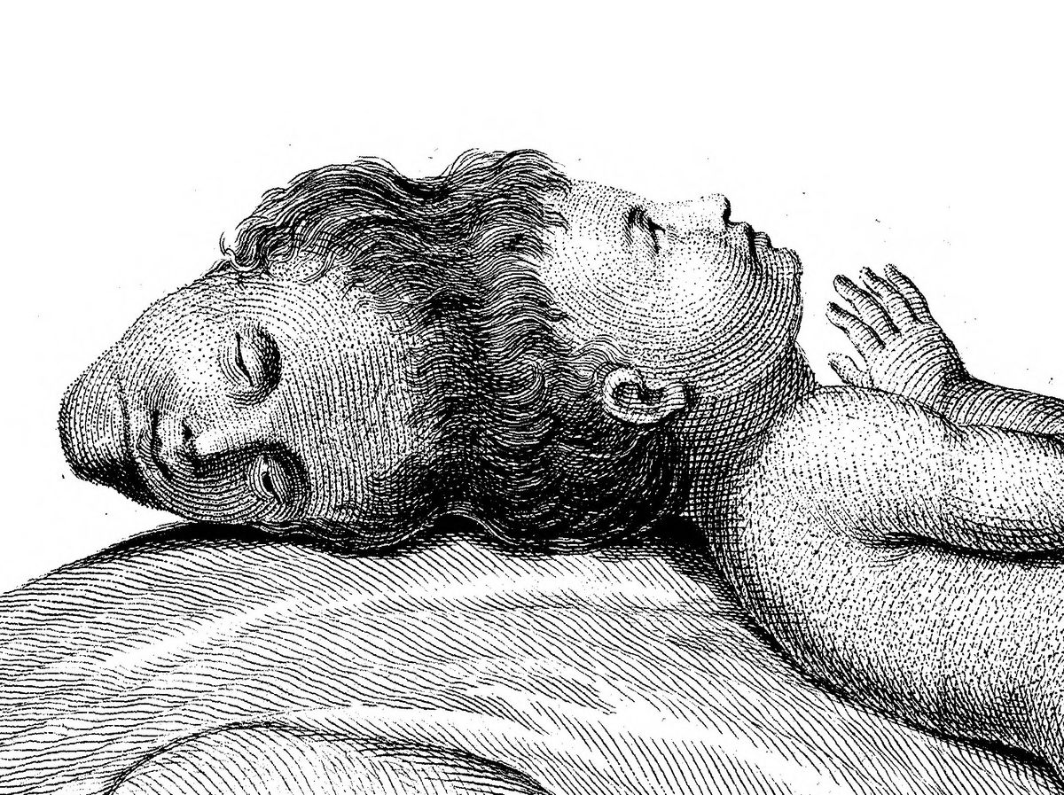 The Extraordinary Tale of a Head Born Without a Body